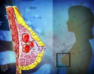 أورام الثدي الصغيرة قد تحتاج مزيدا من العلاج