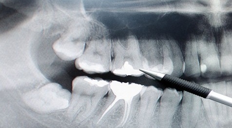  السكري وصحة الفم والأسنان 