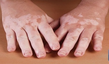  البهاق مرض جلدي شائع ومتعدد الأسباب 