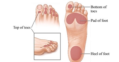 نصائح طبية حول القدم السكرى