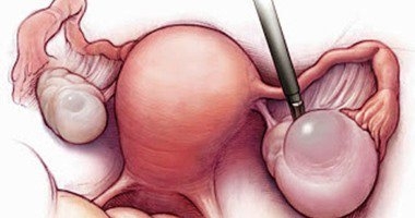 دراسة أسترالية: تكيس المبايض يضاعف من احتمالات الإصابة بأمراض خطرة