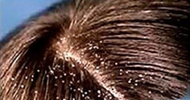 تقرير طبى يوضح 6 أطعمة رائعة تحمى فروة الرأس من القشرة 