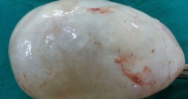 نقيب أطباء الأقصر يستأصل “ورم” حجمه 10 سم بالمنظار عبر فتحة قطرها 0.5 سم