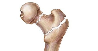 دراسة: الرجال عرضة أيضًا مثل النساء لهشاشة العظام 